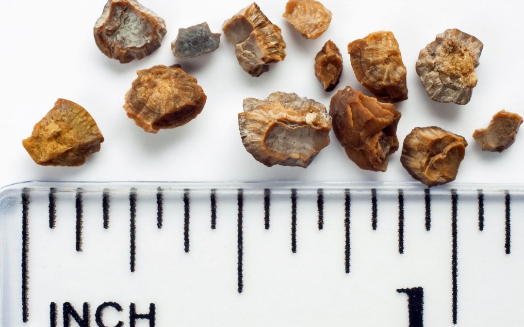 Kidney Stones